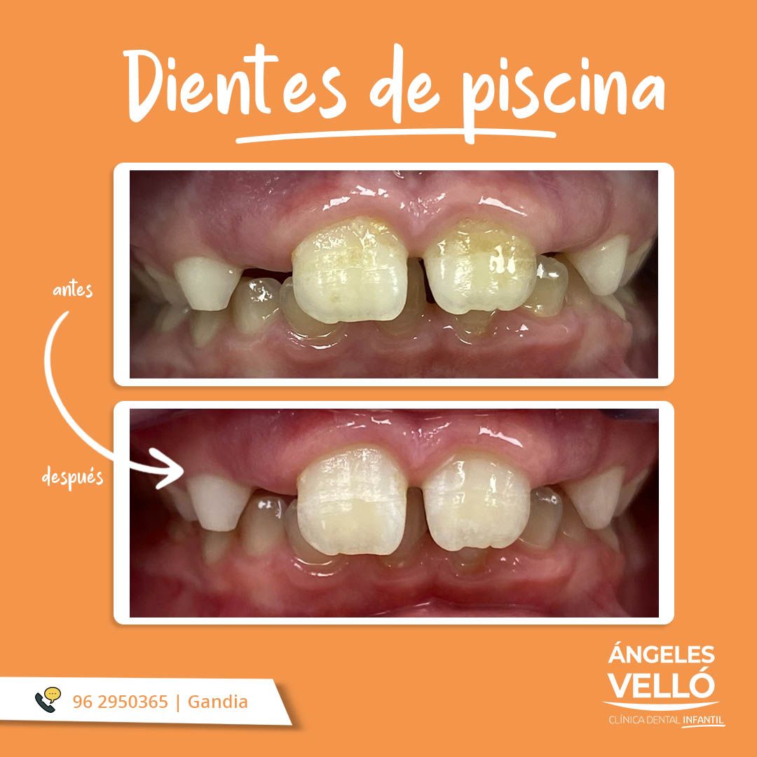 Dientes de piscina